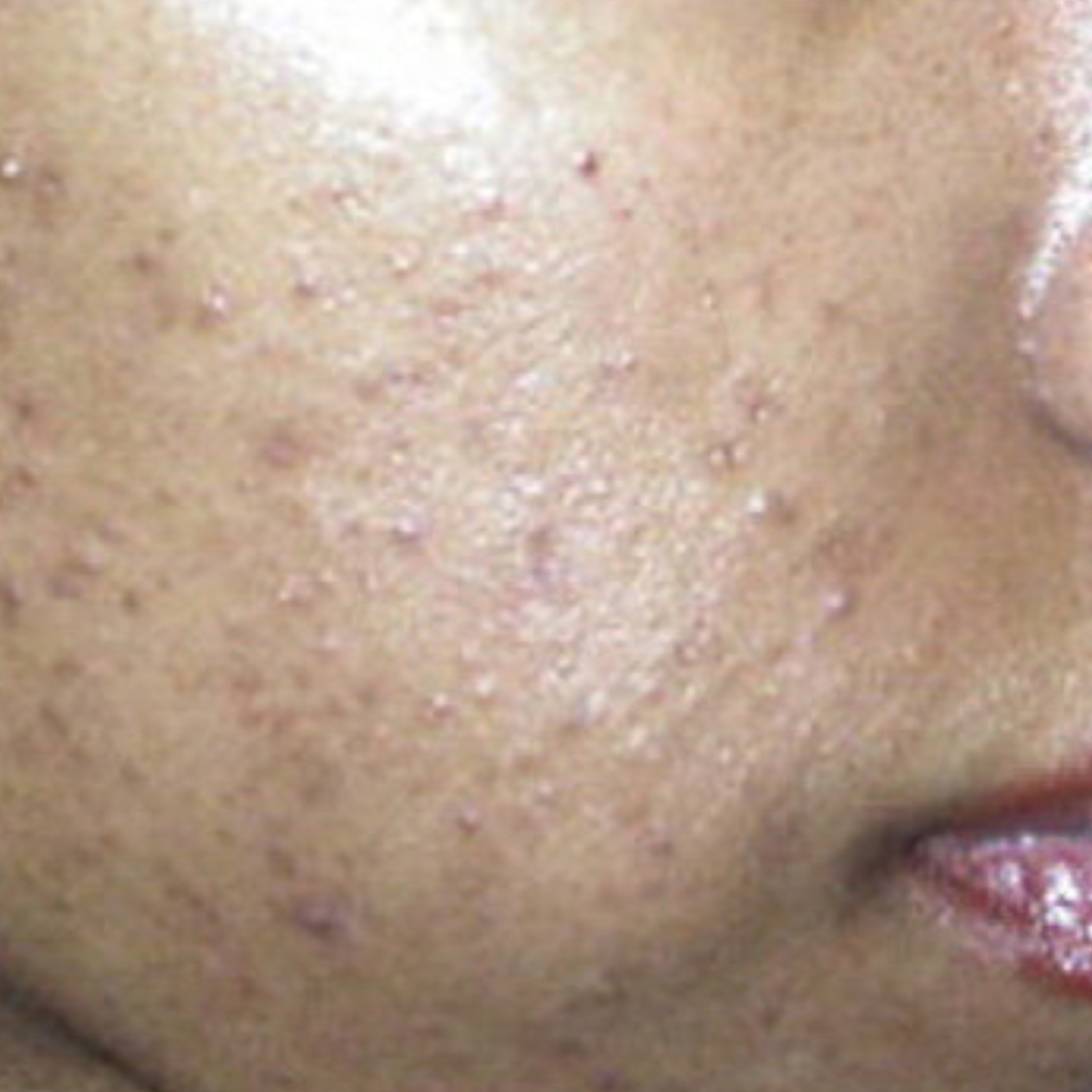 Acne and Pimples