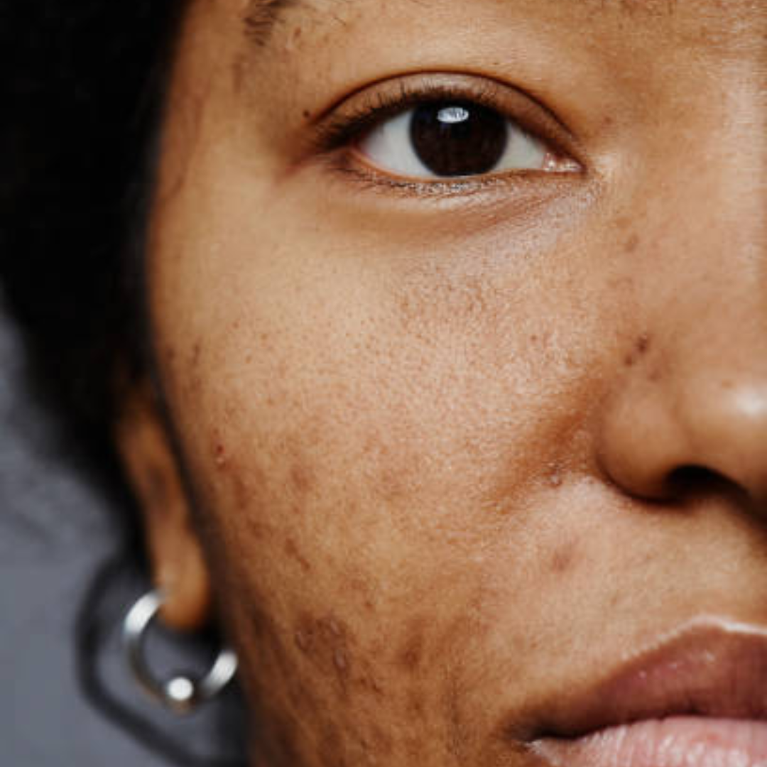 Dark Spots